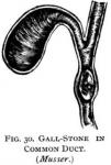 Figure 30. Gall-stone in common duct.
