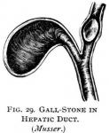Figure 29. Gall-stone in hepatic duct.