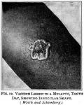 Figure 12. Vaccine lesion in a mulatto