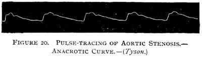 Figure 20. Pulse-tracing of Aortic Stenosis.