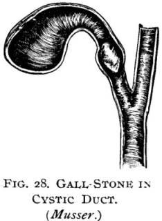 Figure 28. Gall-stone in cystic duct.