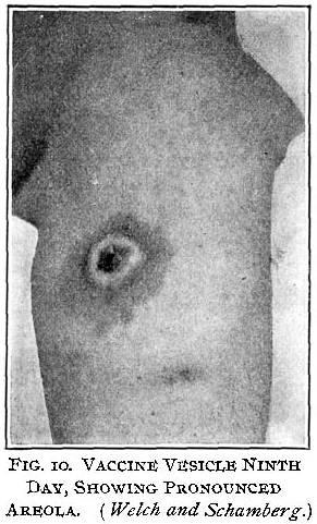 Figure 10. Vaccine vesicle ninth day