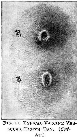 Figure 11. Typical Vaccine vesicles 